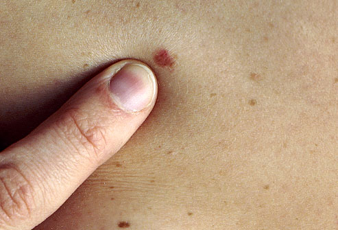 Cancerous Moles What To Look For