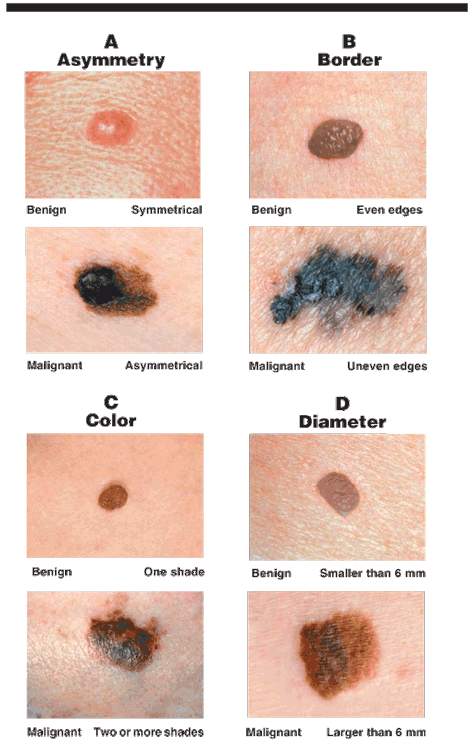 Cancerous Moles What To Look For